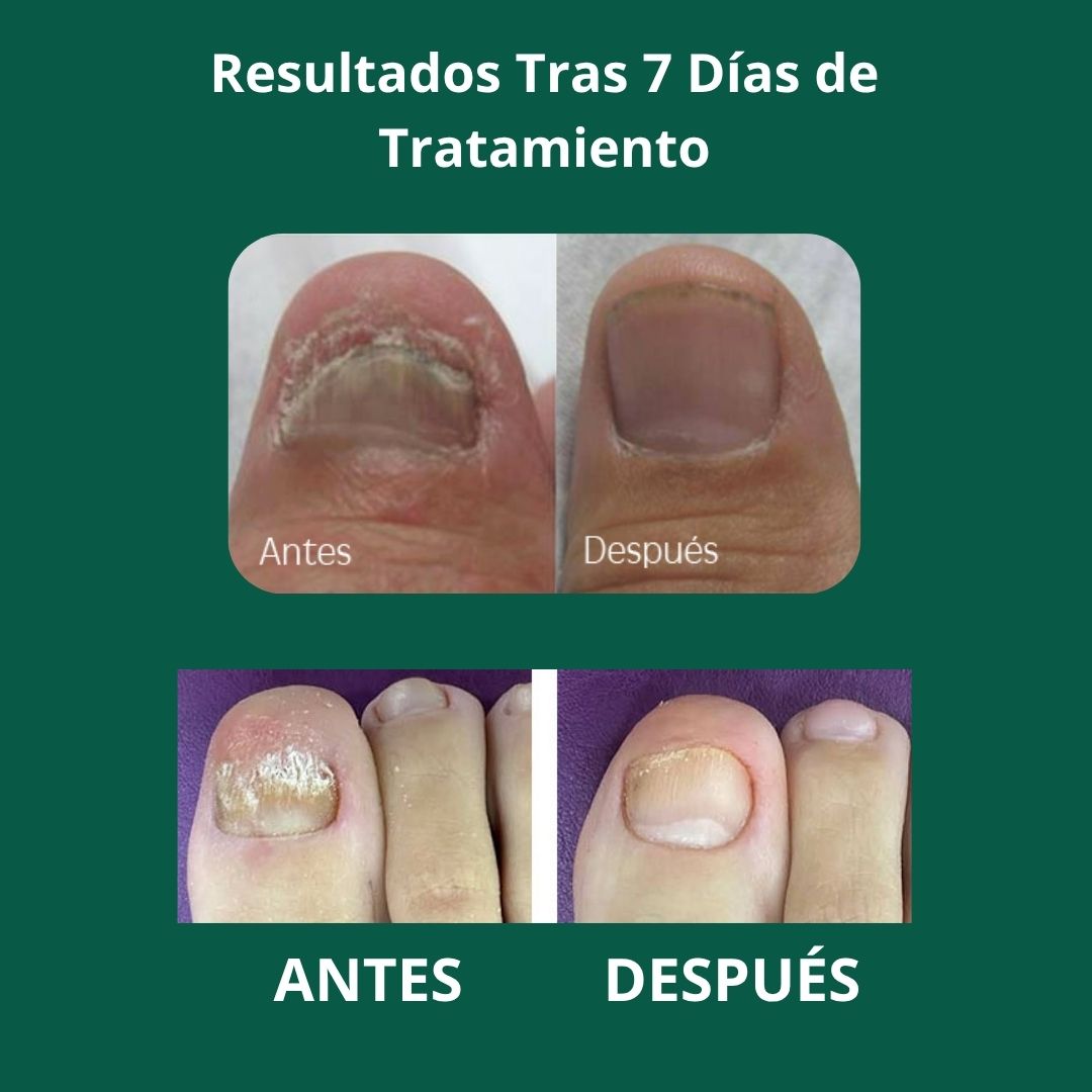 Aceite anti-hongos uñas