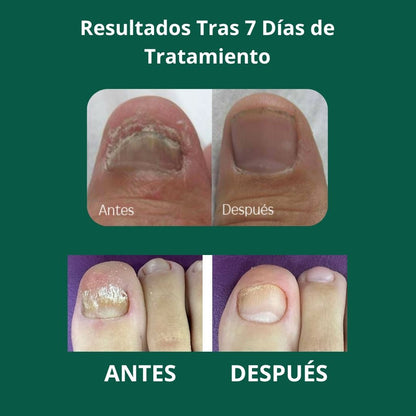 Aceite anti-hongos uñas
