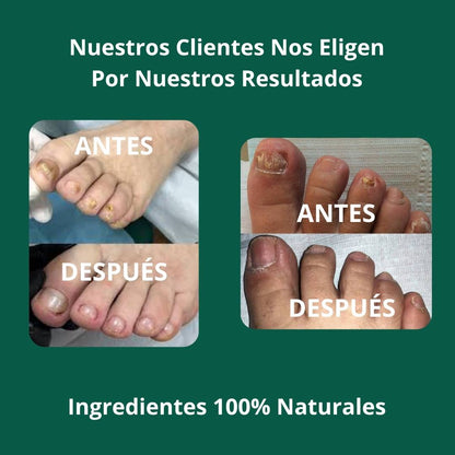 Aceite anti-hongos uñas